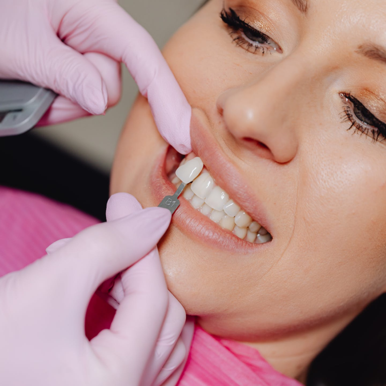 Facetas Dentárias
