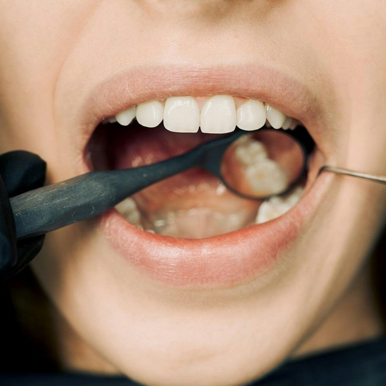 Restaurações Dentárias